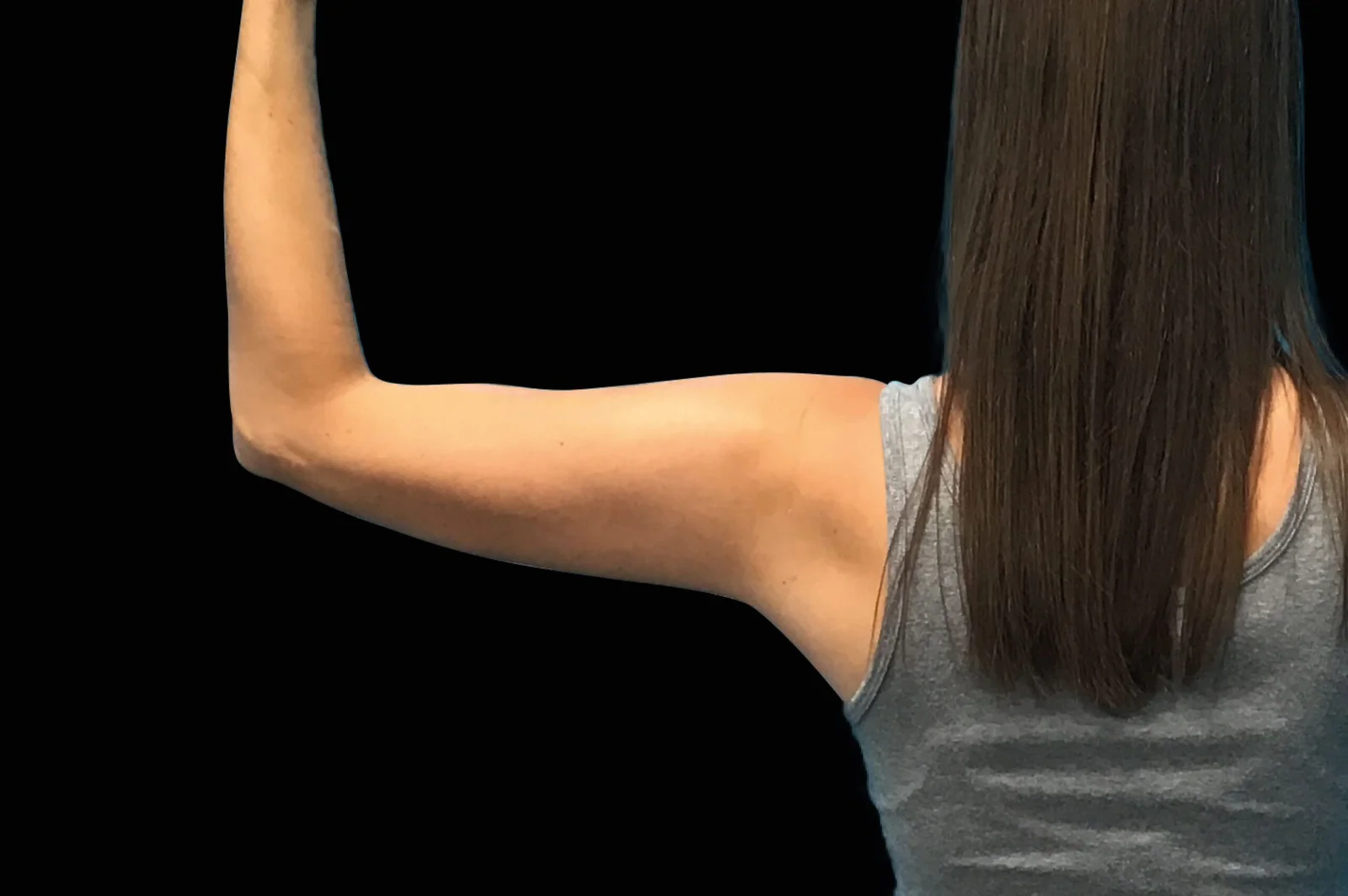 emsculpt-neo-before-after-12-scaled