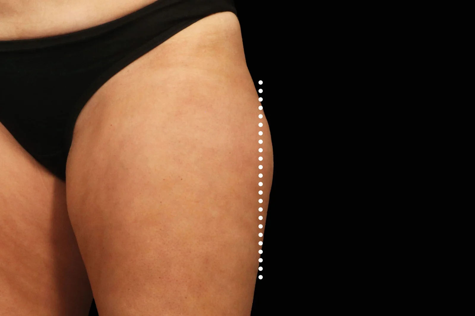 emsculpt-neo-before-after-4-scaled